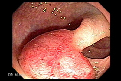 Polipectomía de pólipo pédiculado del colon sigmoides