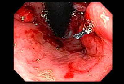 Trasfístula-Esófago-Gastrica Retrograda