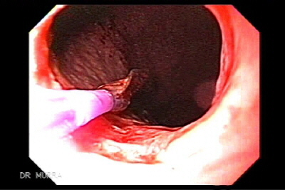 Dilatacion esofago