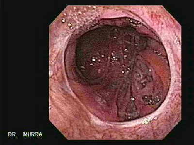 Endoscopia de Esofago gastrectomia