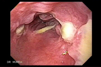 ligadura de várices esofágica