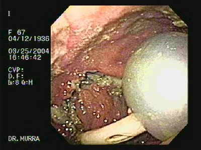 Endoscopia de Esofago gastrectomia