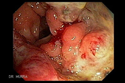 varices rectales Adenocarcinoma colon 