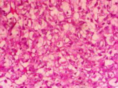 Tumor de células claras