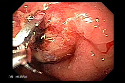Hemorragia Ulcera gastrica clips endoscopia