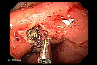 Hemorragia Ulcera gastrica