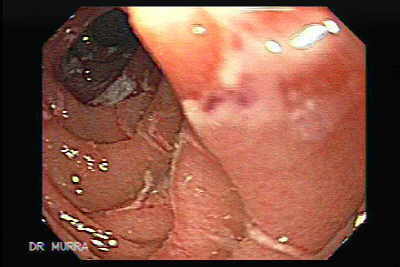 gastroenteritis infecciosa por salmonela enteritis