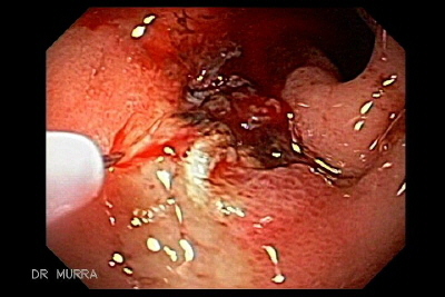Sangrado del Tubo digestivo Ulcera del Duodeno