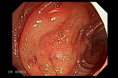 Ulceras Tificas 
