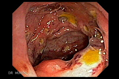 Ulceras Tificas 