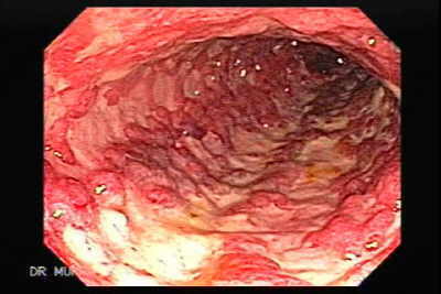 Colitis Ulcerosa con pseudo pólipos