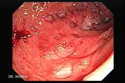 Endoscopia de Colitis Ulcerosa con pseudo pólipos