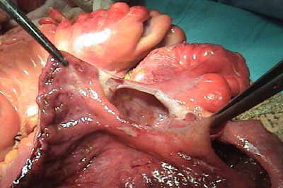 Video de imagen macroscópica de Colitis Ulcerosa Grave.