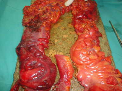Megacolon Tóxico y Colitis Ulcerosa