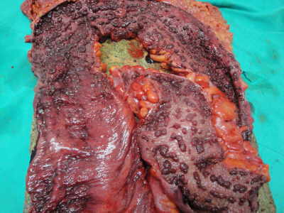Megacolon Tóxico y Colitis Ulcerosa