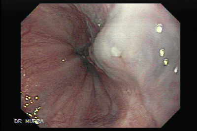 ligadura varices esofagicas