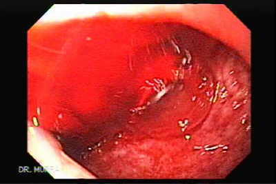 Ulcera Duodenal Sangrante