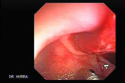 Endoscopia de Ulcera Duodenal Sangrante