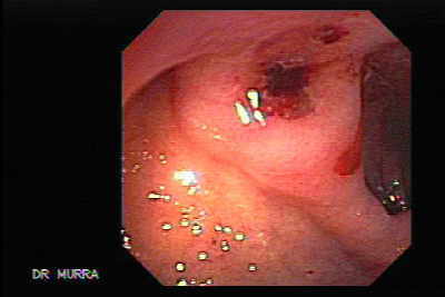 Endoscopia de Ulcera Duodenal Sangrante