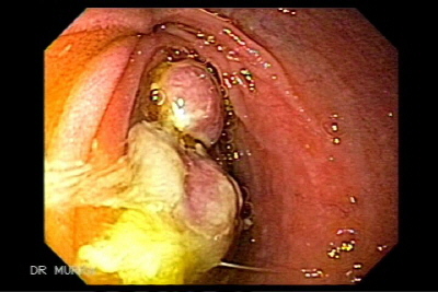 Metastasis de Adenocarcinoma de Ovario a Duodeno