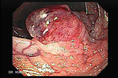 Cancer colon poliposis familiar