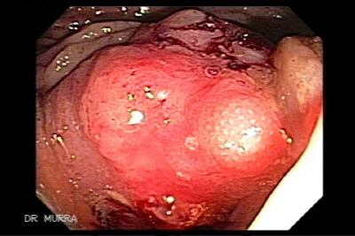 Imagen Endoscópica de Cánceres Sincrónico del Colon, se observa el cáncer del colon ascendente