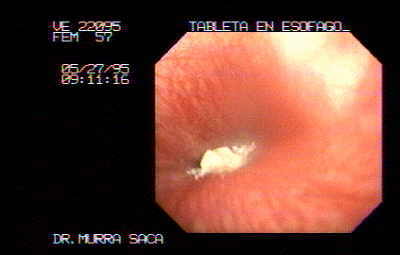 Adenocarcinoma Gástrico ulcerado del fondo.