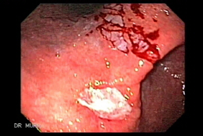 Ulcera Gastrica 