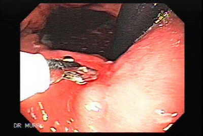 Cicatriz de la úlcera gástrica