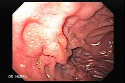 Ulcera Gigante.