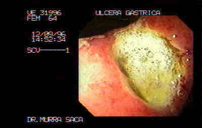 Úlcera Gástrica proximal al ángulo Gástrico.