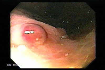 Várice Gastrica Ulcerada con vaso visible
