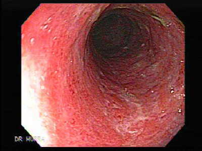 Colitis Ulceros