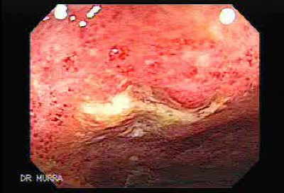 Pancolitis Ulcerosa Inespecífica.