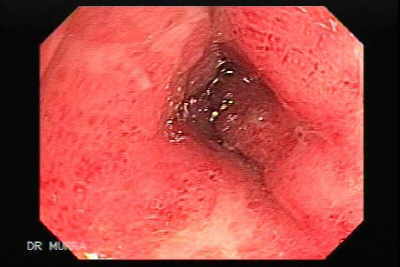 Colitis Ulcerosa con Pseudo Pólipos