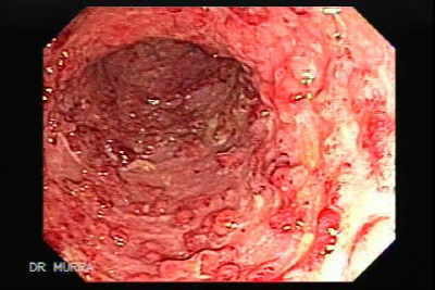 Colitis Ulcerosa con Pseudo Pólipos