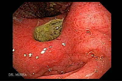 Ulcera Gástrica