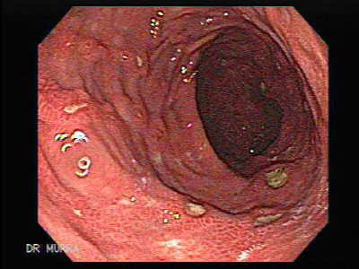 Endoscopia de Múltiples Ulceras.
