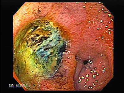 Ulcera Gastrica
