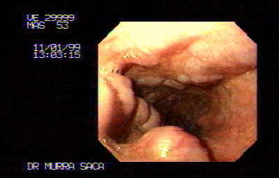 Varices esofago