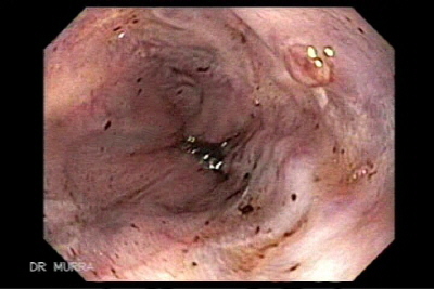 Varice esofago
