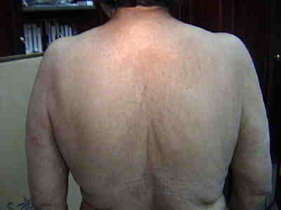 Acantosis Nigricans. Oscurecimiento de su espalda.