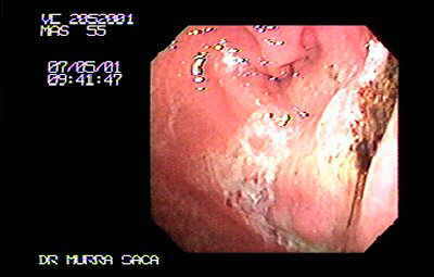 Extensa Ulceración del Antro Gástrico.