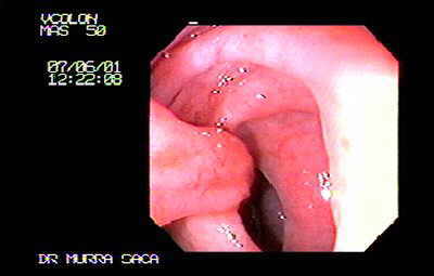 Pólipo bilobulado con un pedículo largo.
