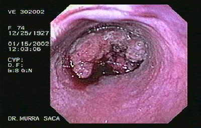 Adenocarcinoma gástrico que protruye hacia el esófago