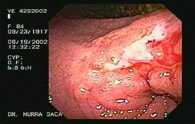Adenocarcinoma Gástrico Ulcerado del Antro con Células