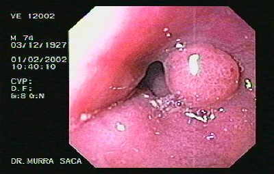Pólipo Gástrico en el cardias con Adenocarcinoma.