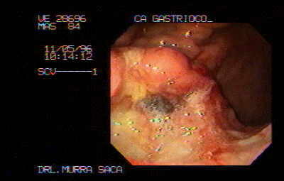 adenocarcinoma 
gástrico ulcerado con células en anillo de sello