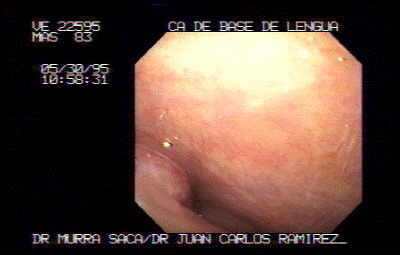 Carcinoma de la Base de la Lengua.