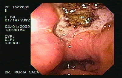 Adenocarcinoma Gástrico Ulcerado con células en anillo